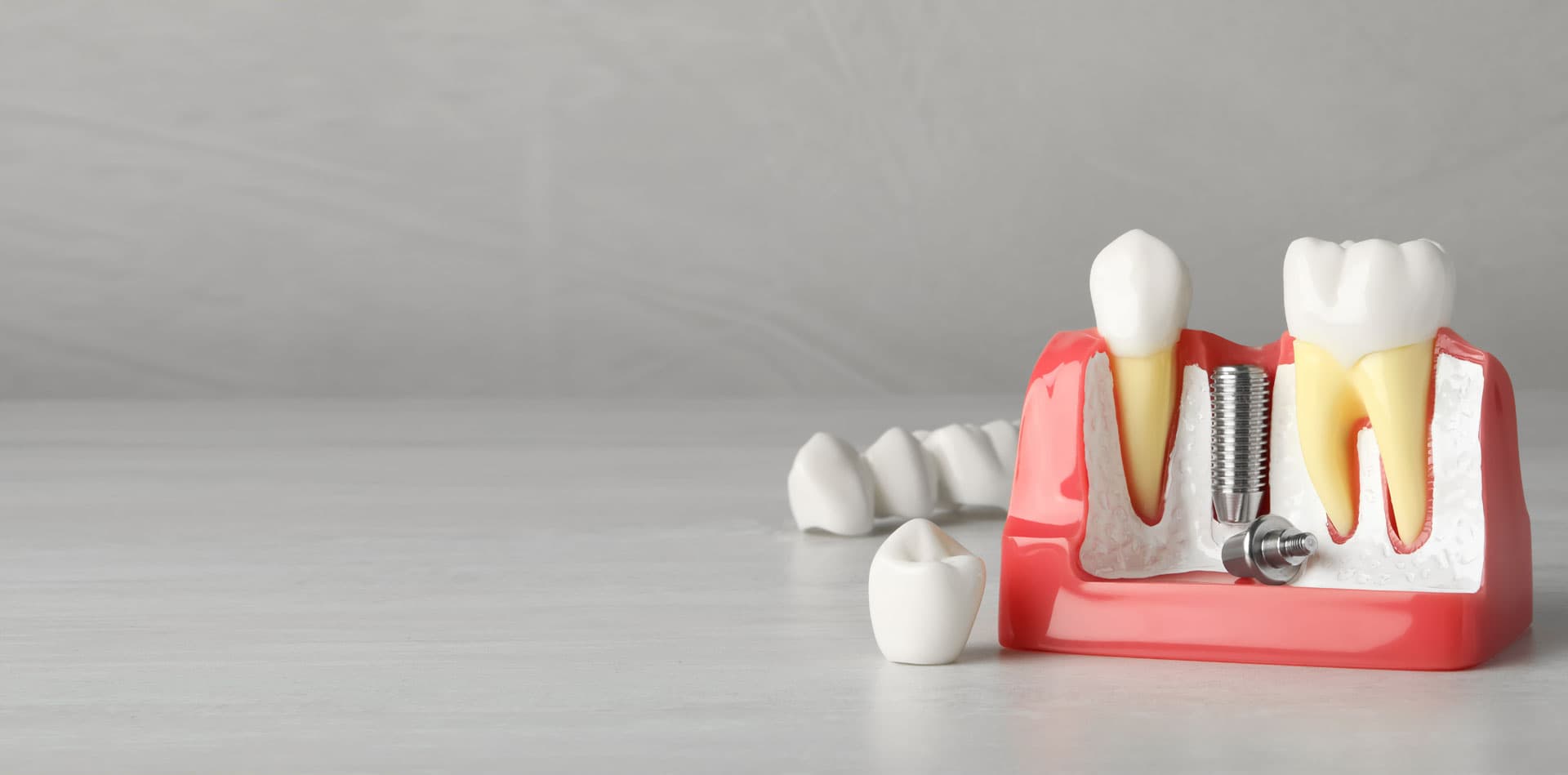 Precio implantes dentales