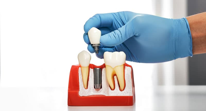 Implantes dentales vigo