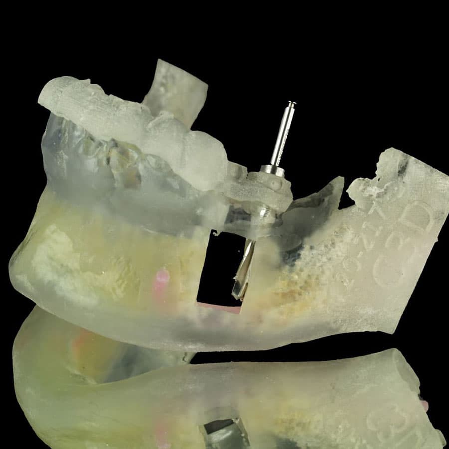 Implantes dentales sin tornillos vigo