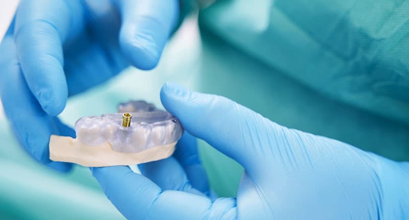 Implantes dentales vigo
